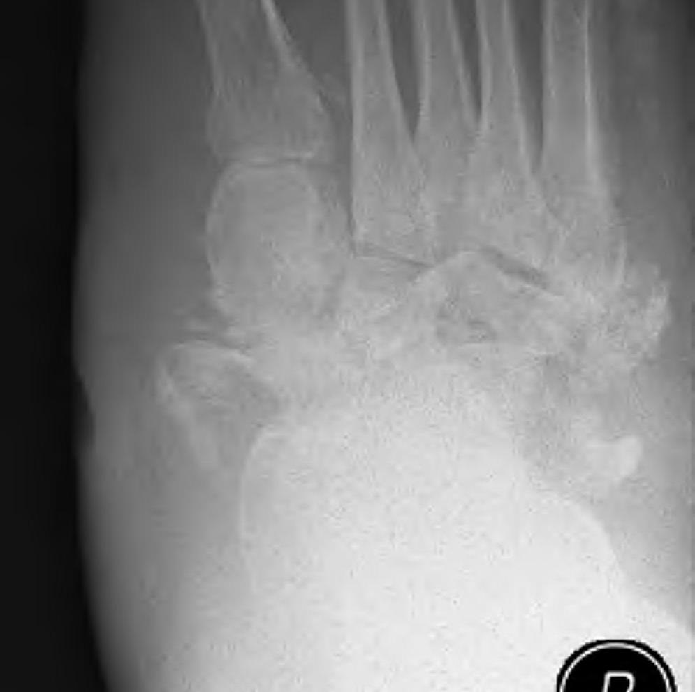 Charcot Foot Stage 1 Fragmentation